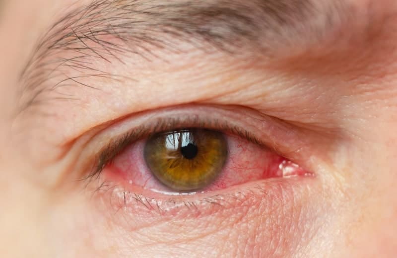 Eye Irritation
