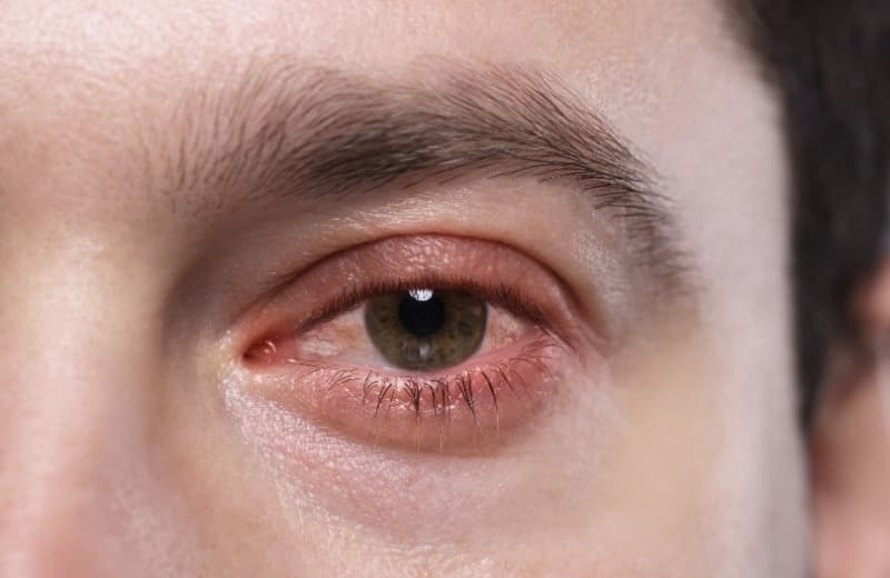 Causes of Eye Infections: Symptoms, Types and Treatments