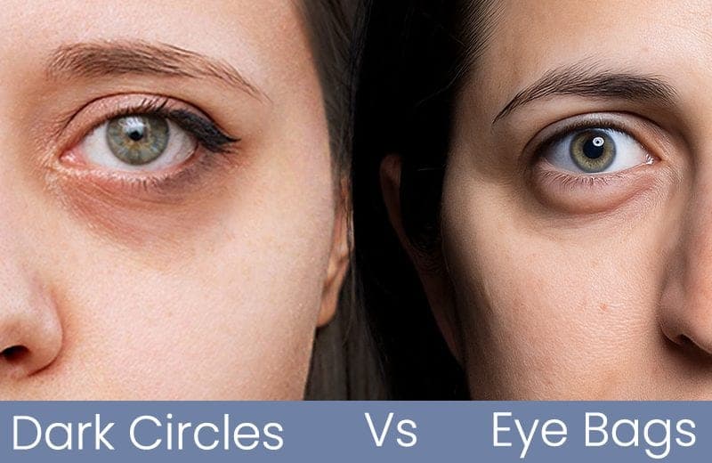Dark Circles vs Eye Bags: Know the Real Difference and How to Treat Them