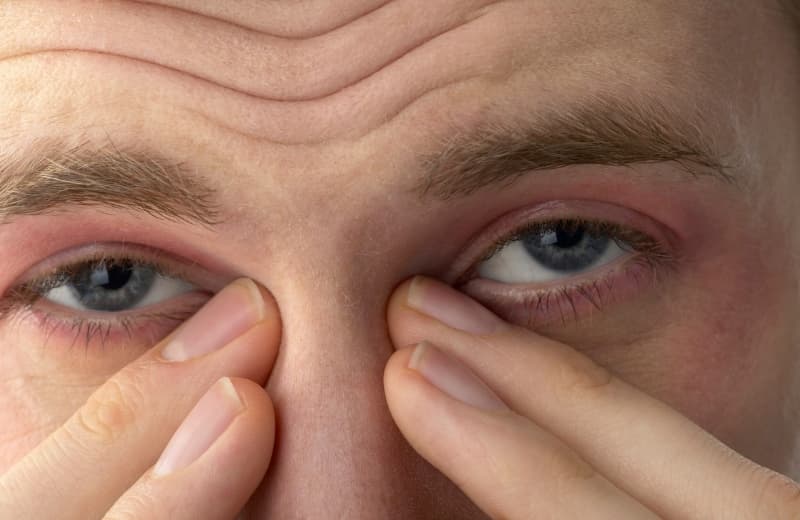 Itchy Watery Eyes: Causes, Relief, and Treatment Options