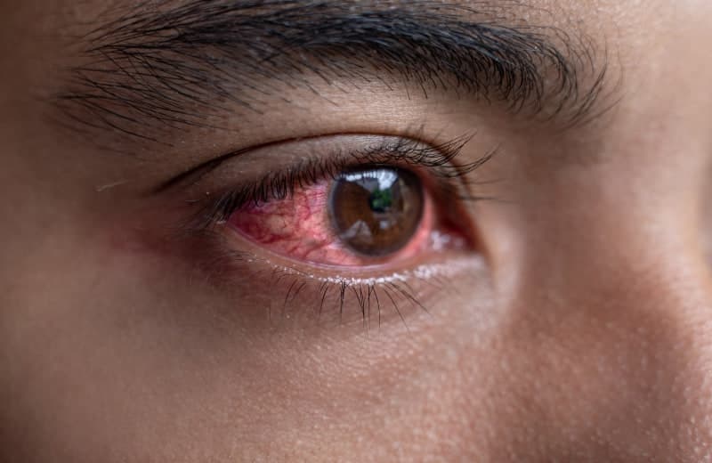 Red Eyes: Causes and Treatments
