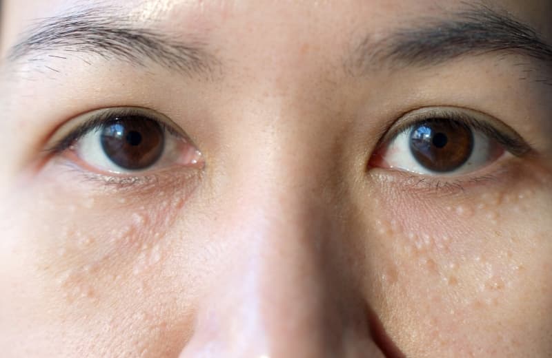 White Spots Around Eyes: Everything You Need To Know About Milia