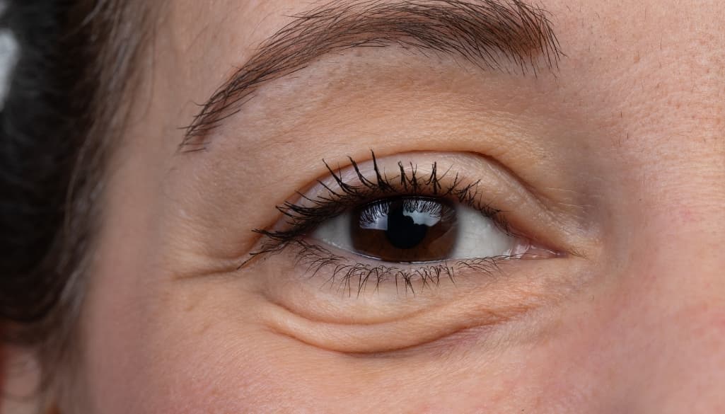 Malar Bags: Causes, Symptoms & Best Treatments to Smooth Your Cheeks