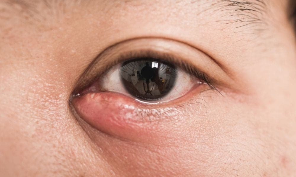 Can A Stye Cause Blurry Vision? Causes, Symptoms, And Treatments