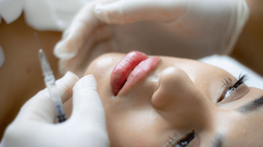 Lip Filler Migration: Causes, Signs and Treatment Options