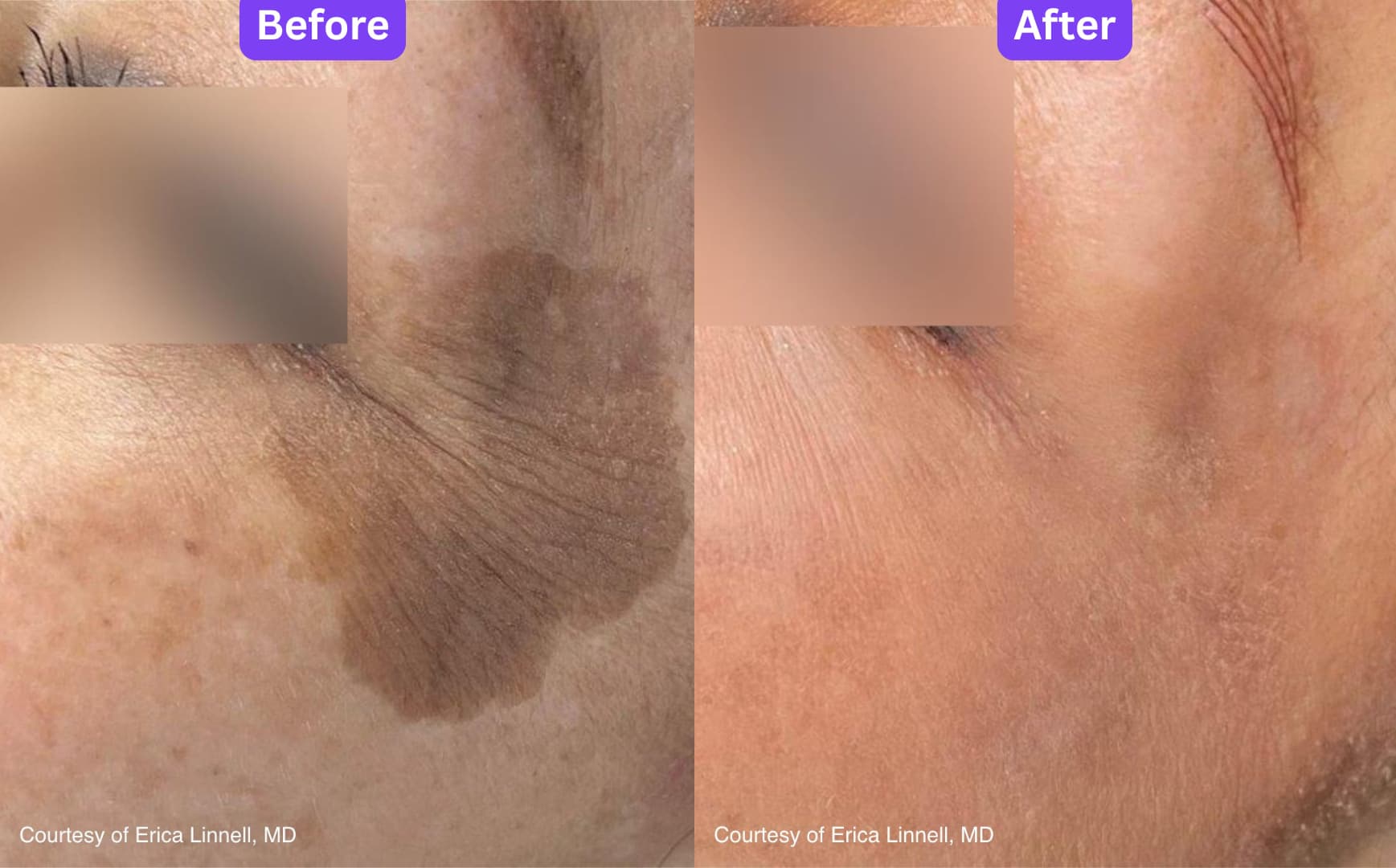 A cheek before and after UltraClear laser resurfacing, showing a large area of pigmentation much reduced. Courtesy of Erica Linnell, MD