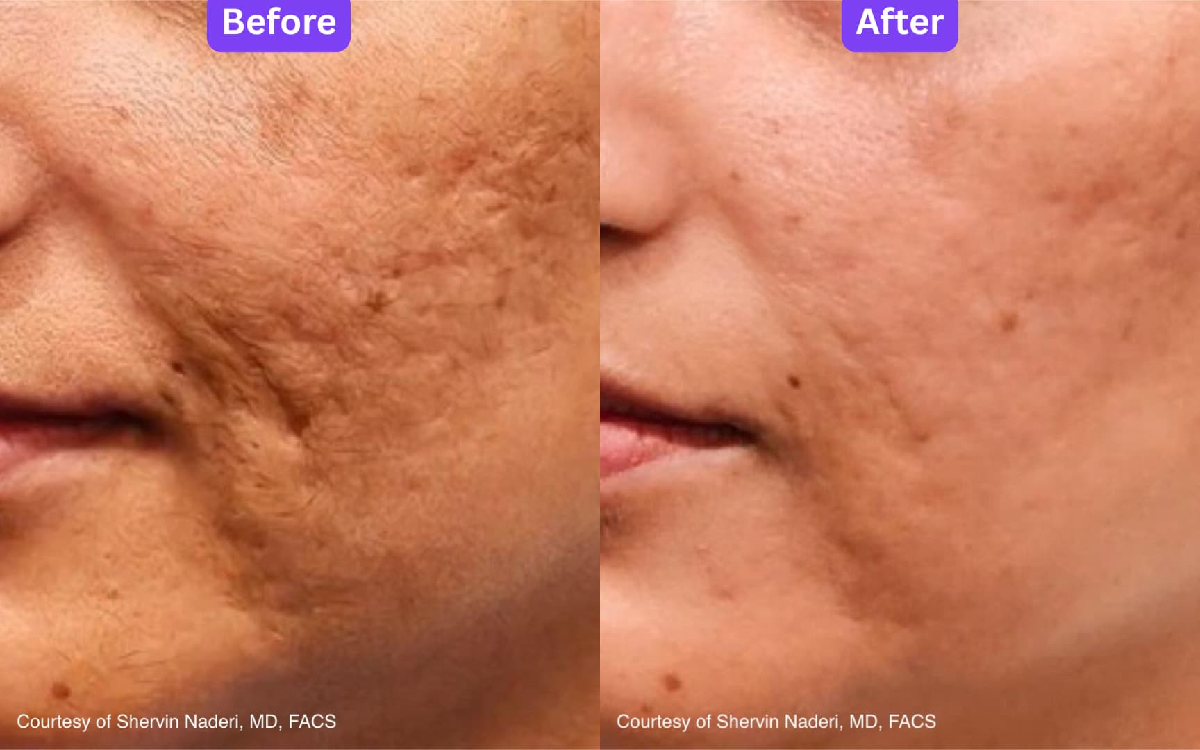 A cheek before and after UltraClear laser resurfacing, showing acne scarring and texture much reduced. Courtesy of Shervin Naderi, MD, FACS