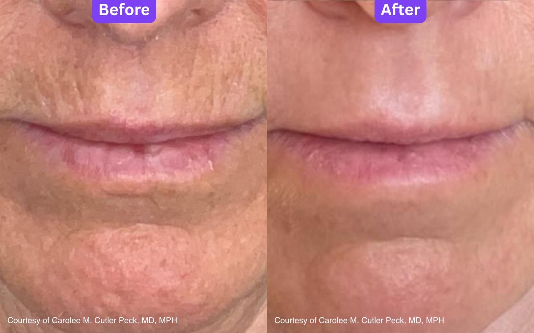 The mouth area before and after UltraClear laser resurfacing, showing lines around the lips much softened. Courtesy of Carolee M. Cutler Peck, MD, MPH