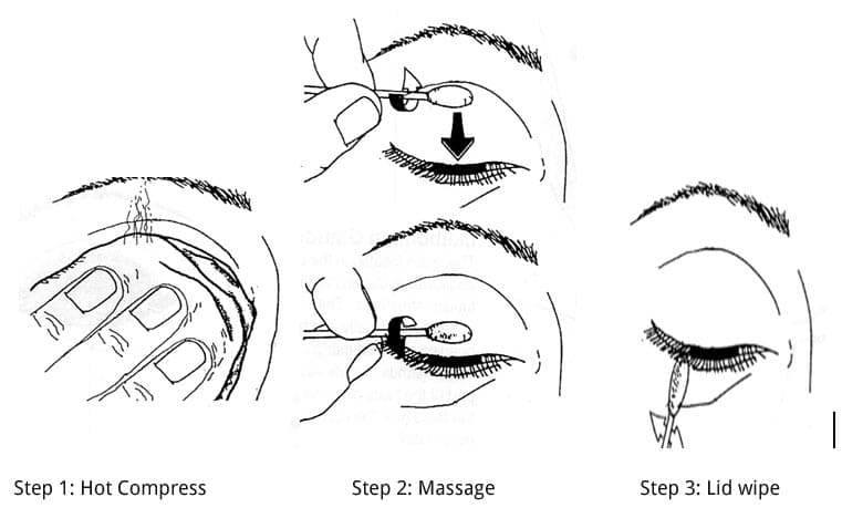 Blepharitis eyelid margin