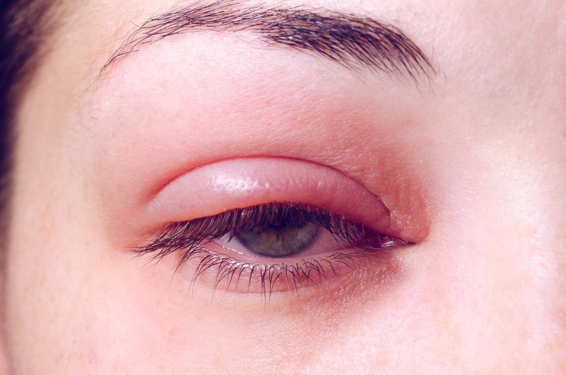 Blepharitis treatment