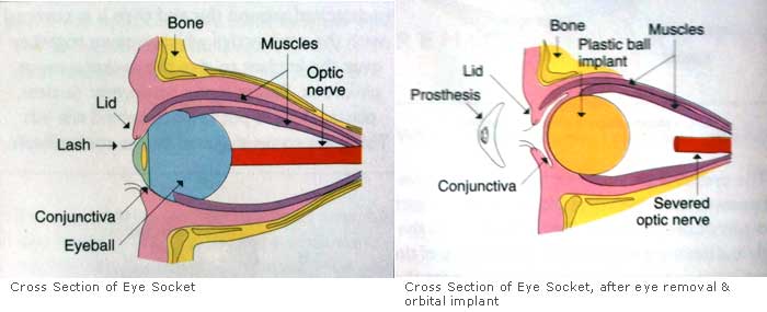 Cross section of the eye socket before and after eye removal and orbital implant