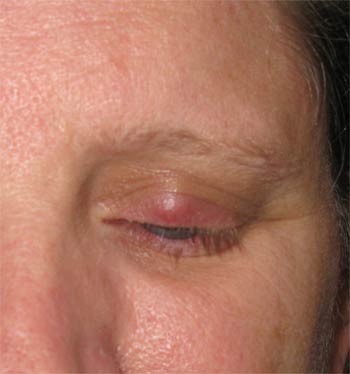 Chalazion lump on the eyelid