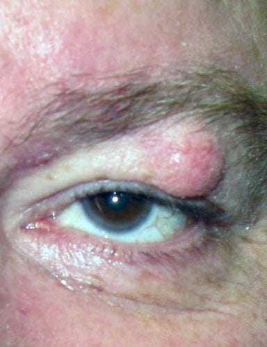 Xanthelasma lump on the eyelid