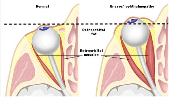 Enlargement of the fat and extra ocular muscles of the eye socket in Graves Orbitopathy