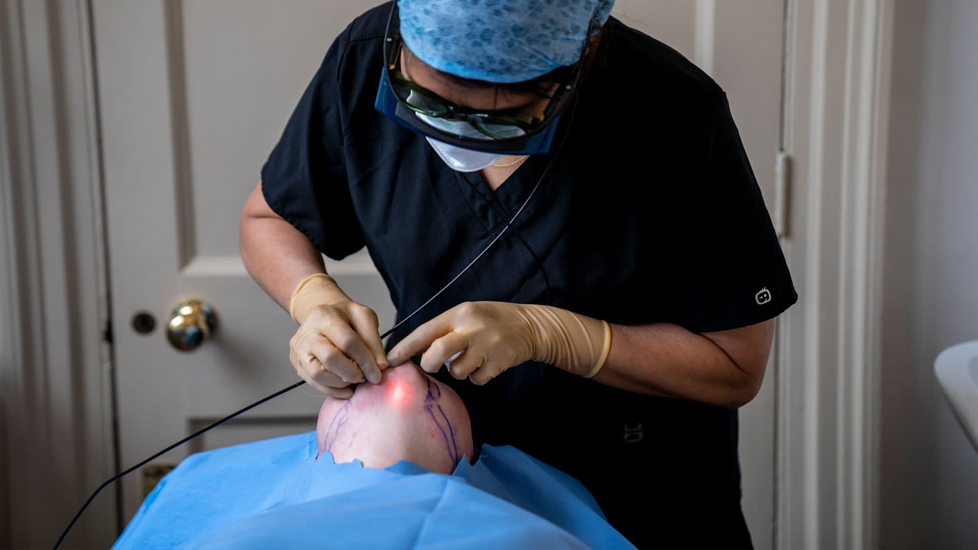 Endolift laser fibre being inserted during treatment