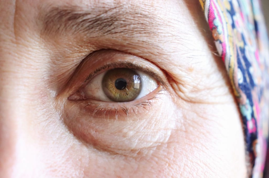 Close-up of an older woman's eye showing crepey skin and visible fullness over the cheekbone, the tissue changes that make malar bags more prominent with age