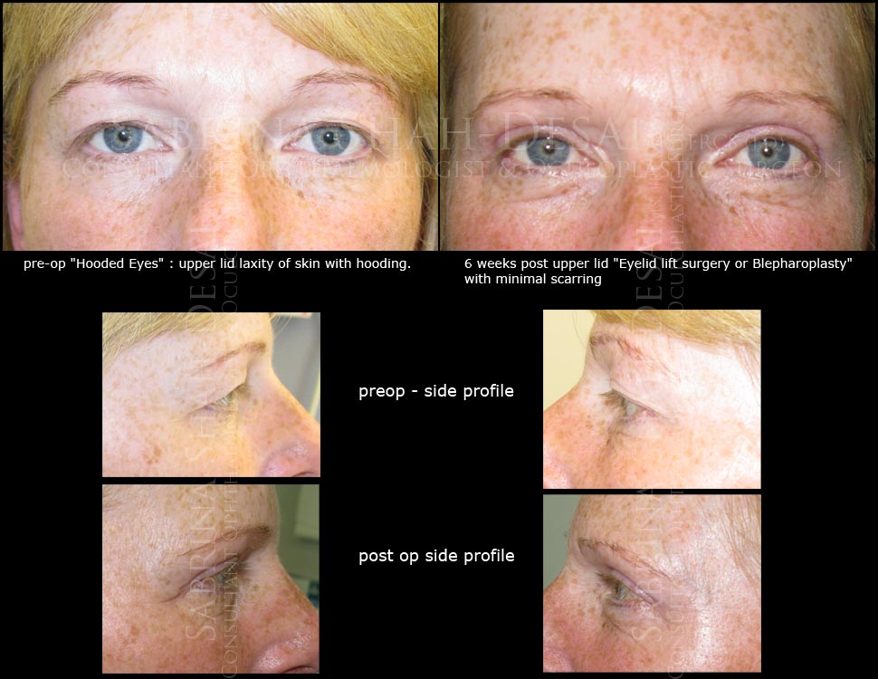 Before and After Eyelid Treatment by a UK Eyelid Surgeon