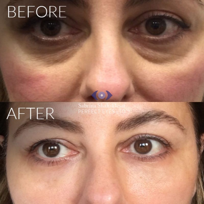 Tear Trough Fillers A Solution To Dark Circles Eye Bags Hollows