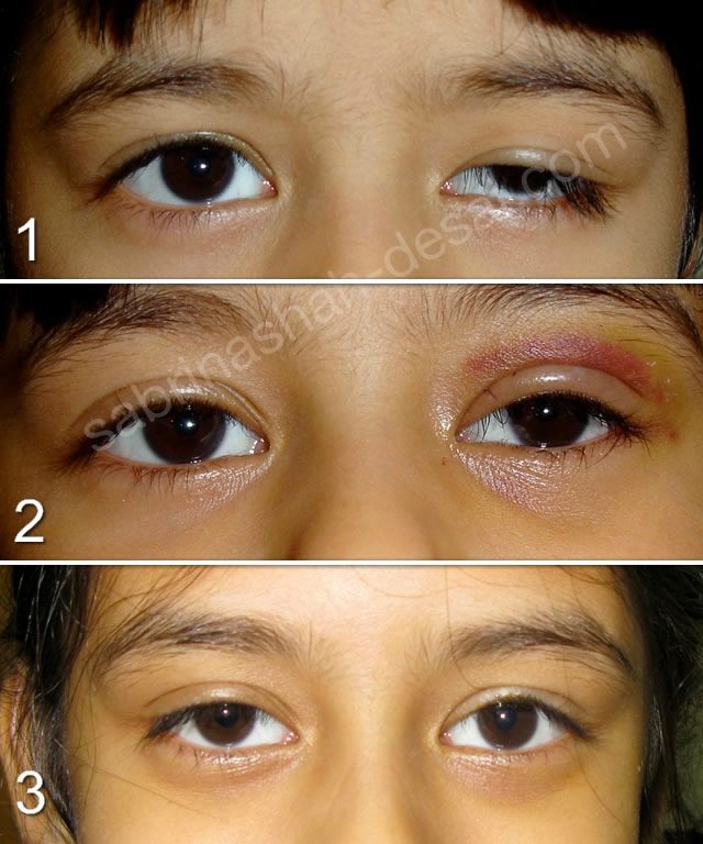 eyelid ptosis surgery