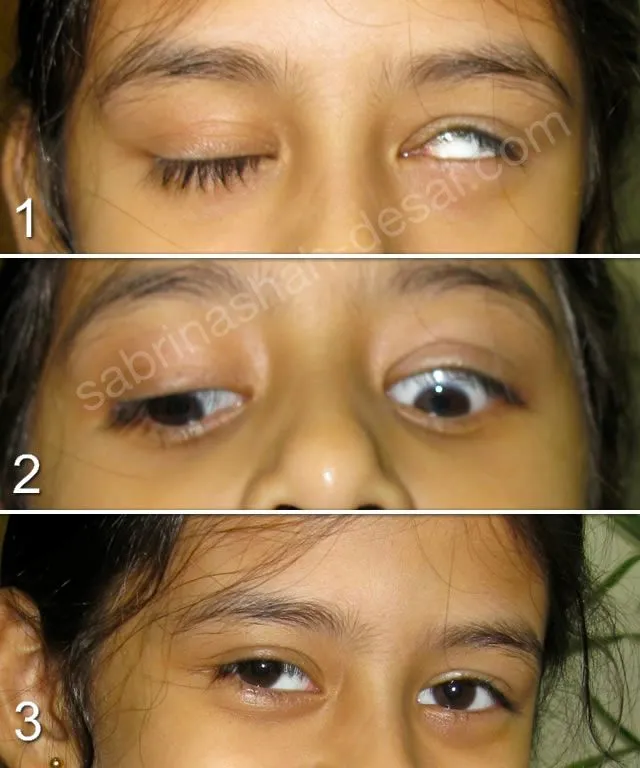 can ptosis be corrected