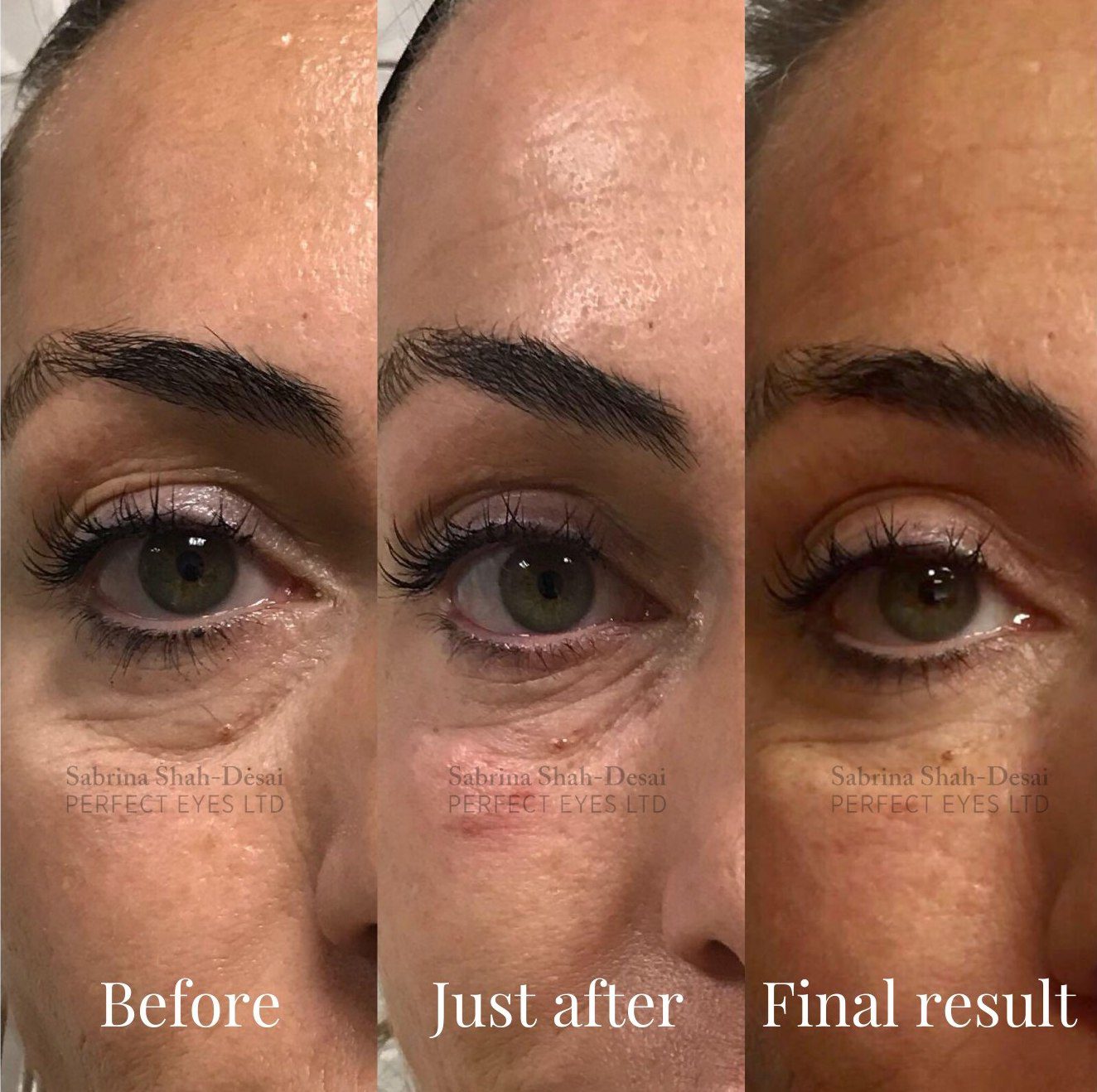 Tear Trough Fillers A Solution To Dark Circles Eye Bags Hollows 