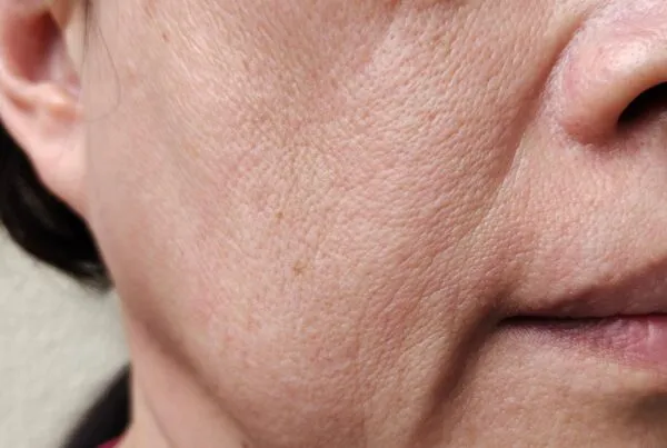 Sagging Jowls