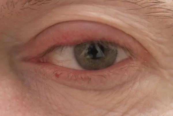 A person is seeing Why My Eyelid is Swollen